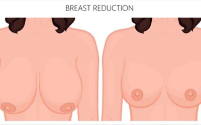 Breast Reduction Surgery, What You Should Know…