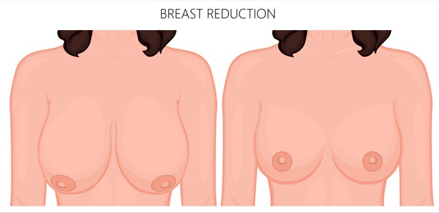 Breast reduction photo