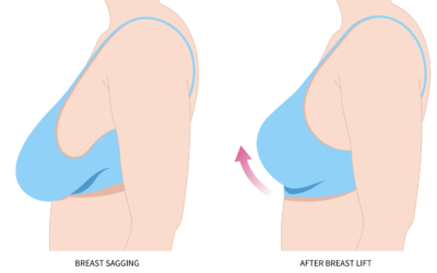 Mastopexy Augmentation