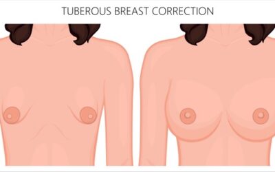 Tubular Breasts